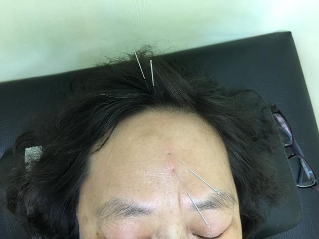 偏頭痛-61歲女性