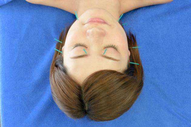 顏面神經麻痺療效概論